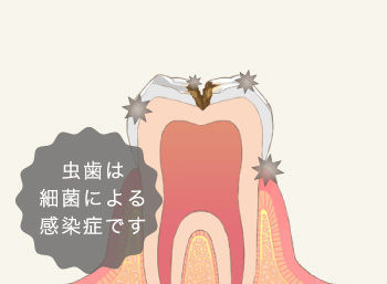 虫歯は細菌による感染症です