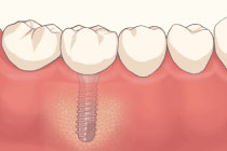 インプラント