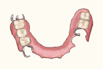 義歯（入れ歯）